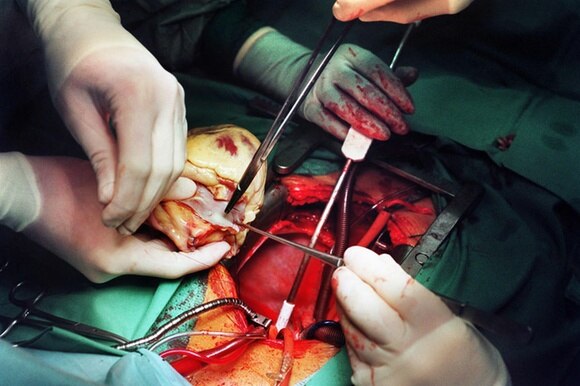 Un cuore in mano a un chirurgo poco prima di essere trapiantato nel nuovo corpo